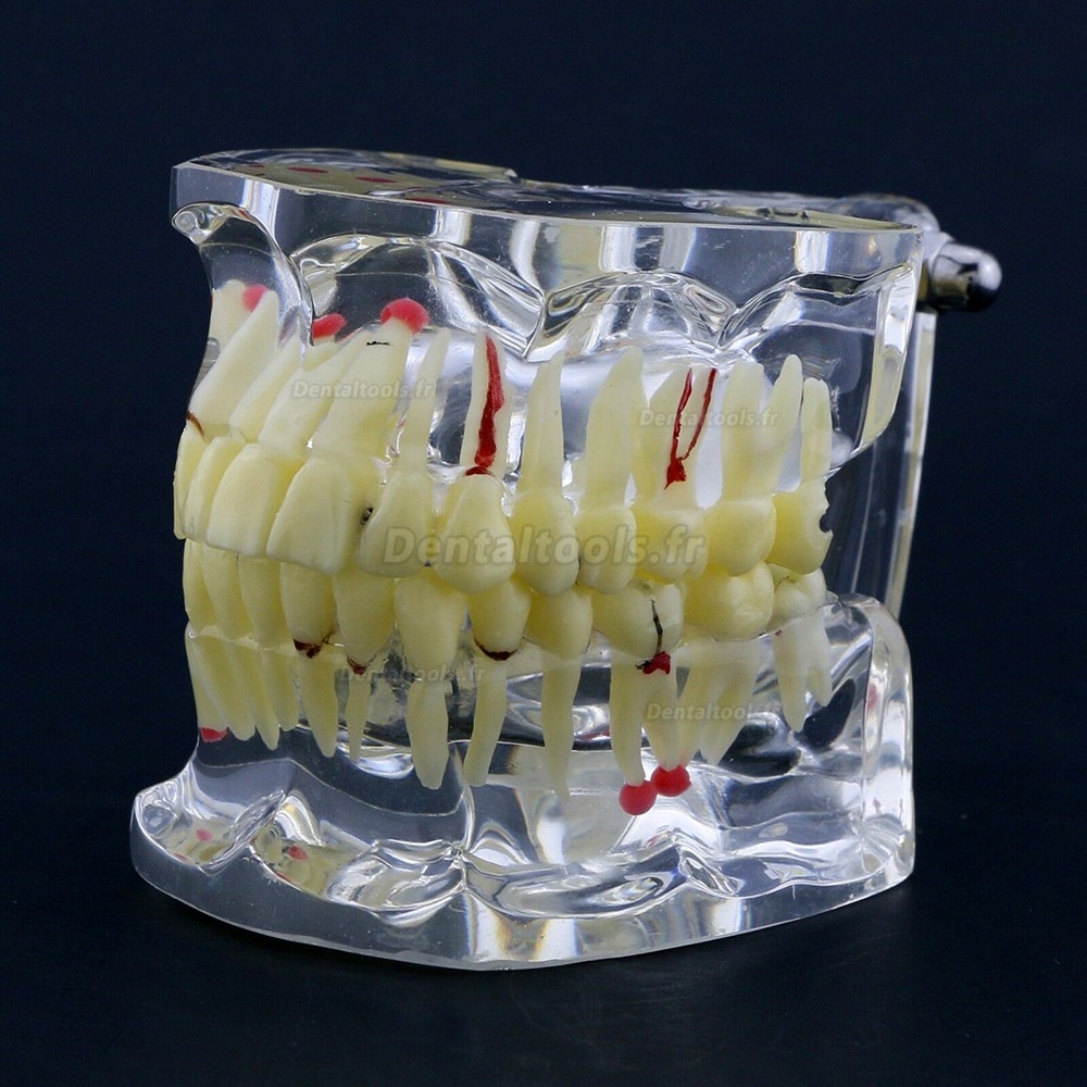 Modèle de dents #4001 pour l’étude et enseignement générale de pathologie Typodont adulte
