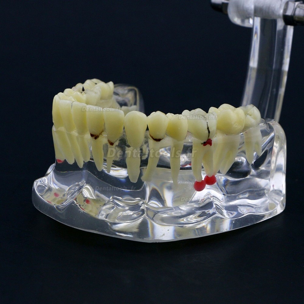 Modèle de dents #4001 pour l’étude et enseignement générale de pathologie Typodont adulte