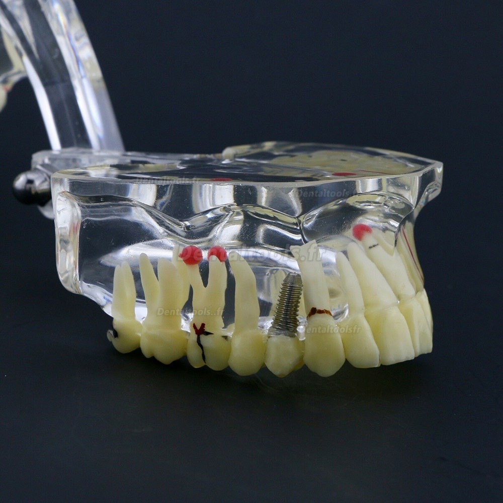 Modèle de dents #4001 pour l’étude et enseignement générale de pathologie Typodont adulte
