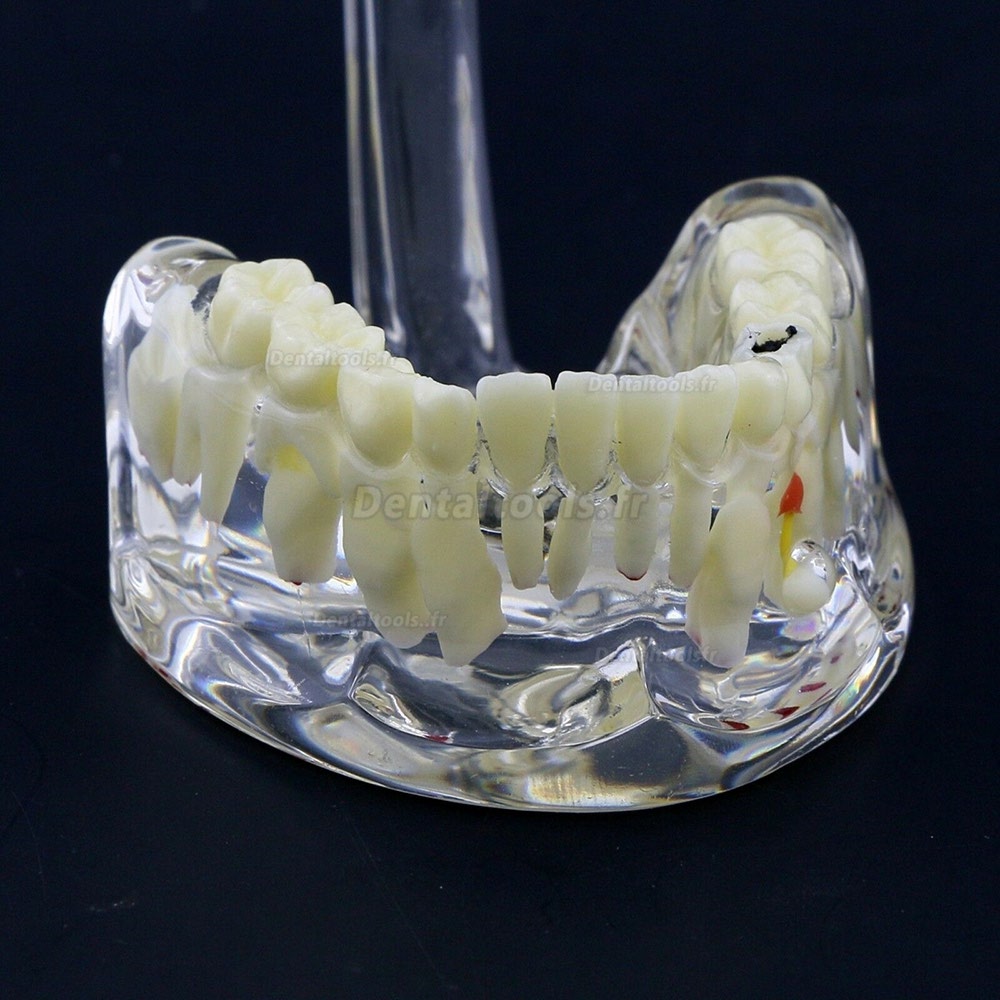 Vente de Modèle de dents d'enfants Modèle d'étude de démonstration en  pathologie pédiatrique 4002 en ligne 