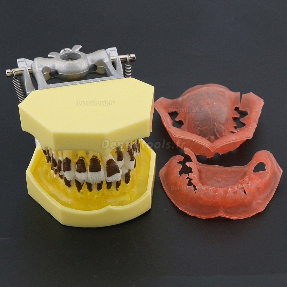 Dentaire Modèle de maladie parodontose démontre des calculs gingivés enflammés 4003