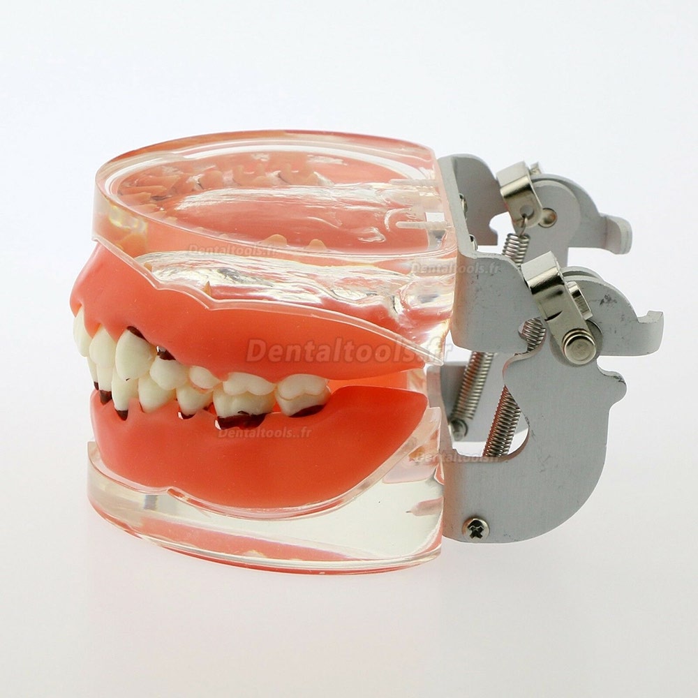 Modèle de dents de maladie Dental modèle de dent orale modèle Medisch  implantation de