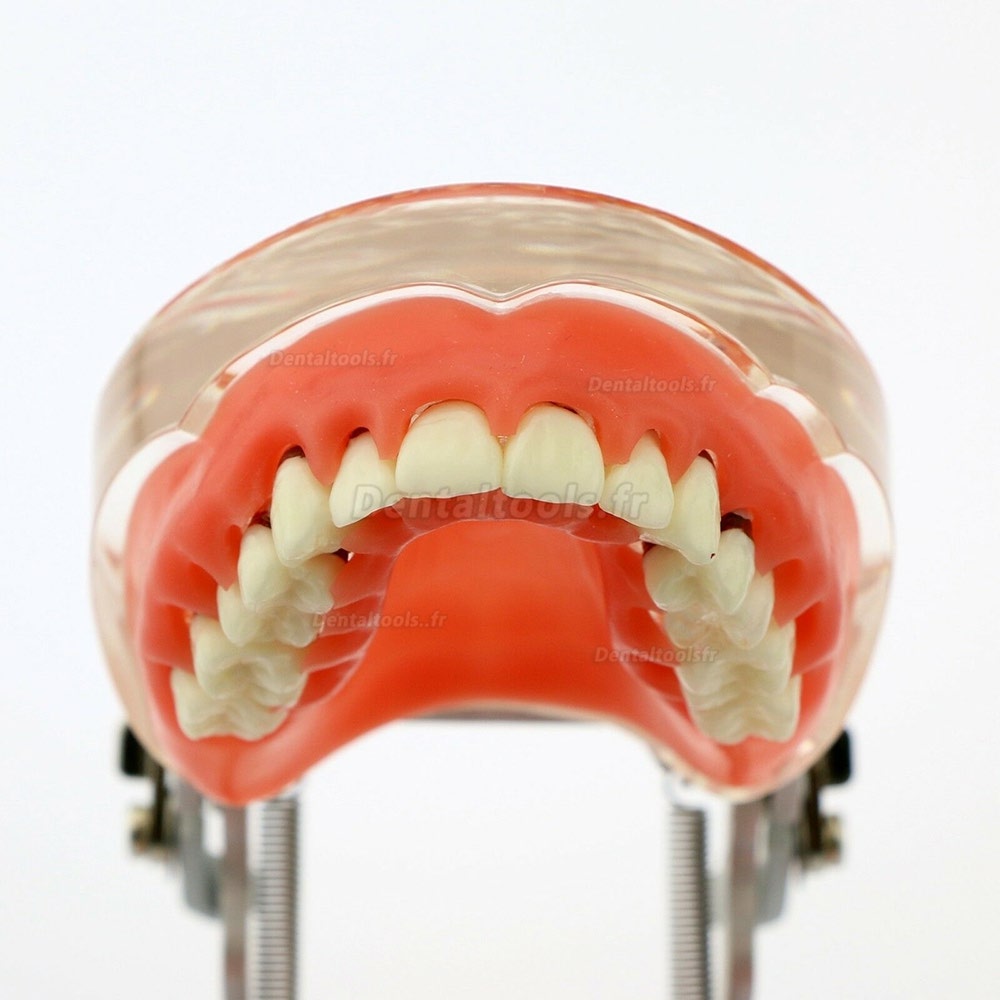 Modèle dentaire Modèle d'étude de la maladie parodontale pathologique chez l'adulte 4017