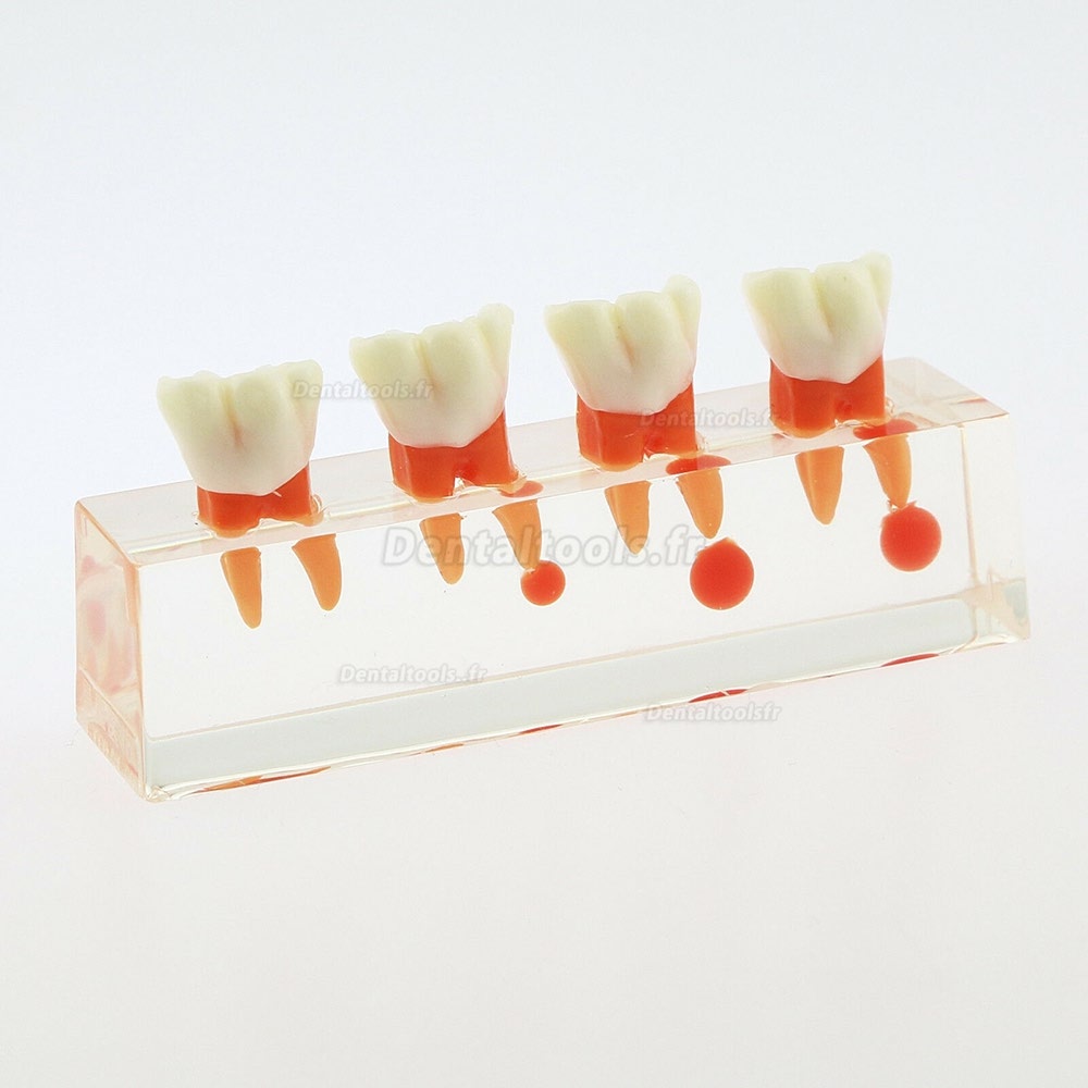 73/5000 Étude de traitement endodontique à 4 étapes de modèle de dents dentaires Teach Model 4018 01