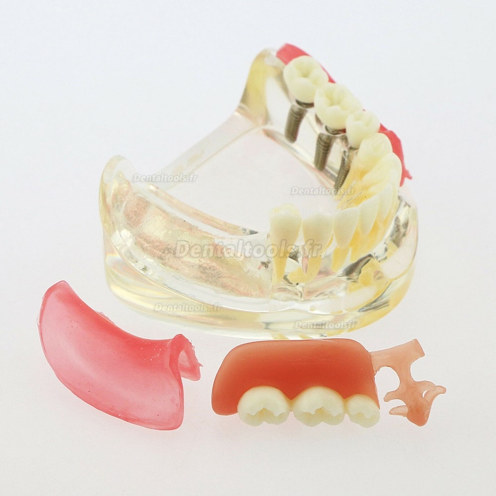 Modèle de démonstration de pont amovible d'implant de restauration de modèle de dents inférieures dentaires 6006