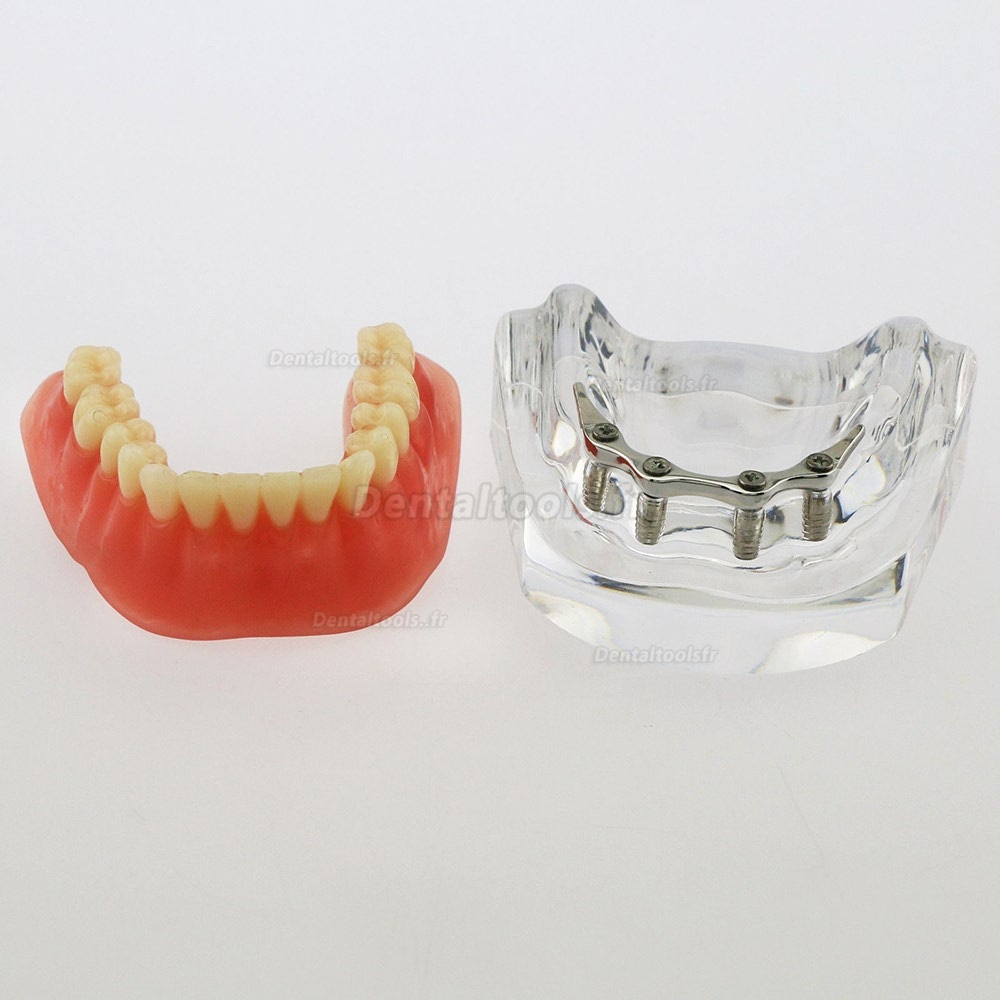 Dentaire inférieur Modèle de dents Overdenture Précision 4 implants Manifestation Bar d'Argent