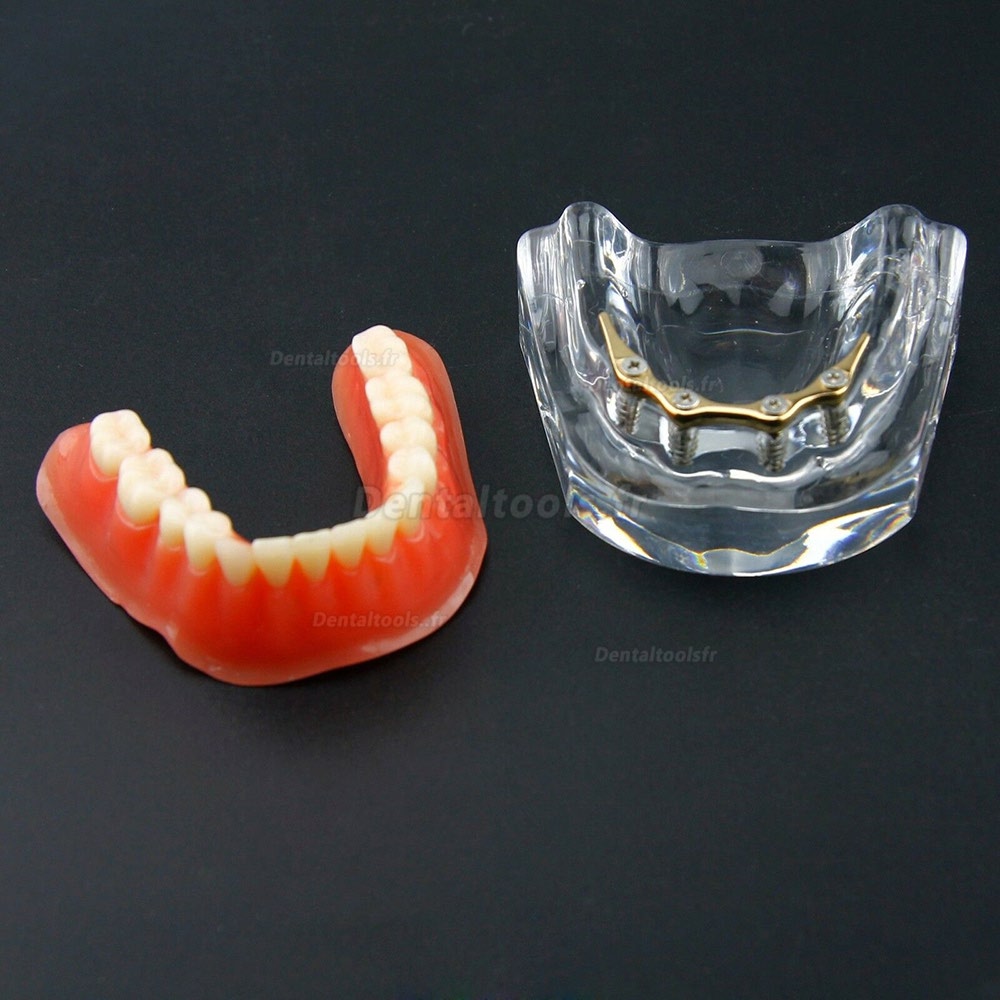 Dentaire modèle Typodont implant de précision inférieure 4 implants 6009 doré