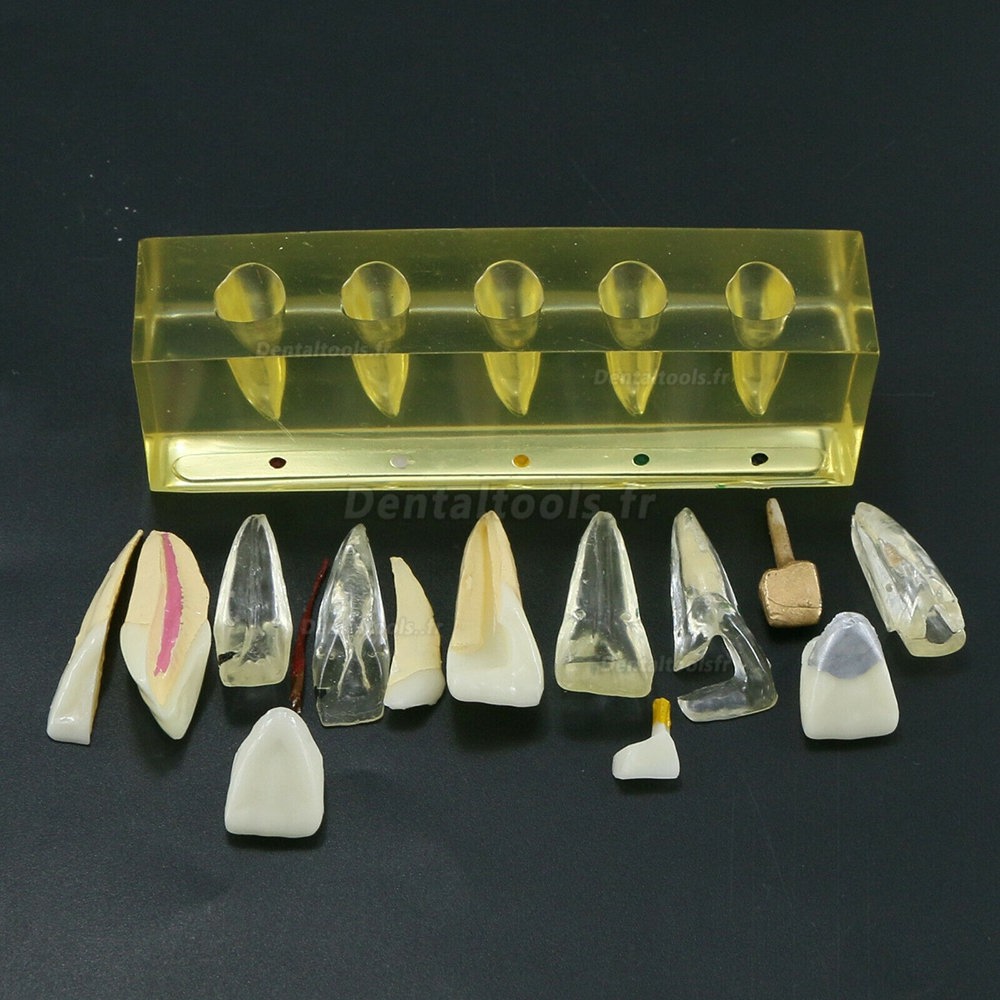 Dents dentaires modèle 5 étapes de démonstration de traitement endodontique incisive de canal radiculaire