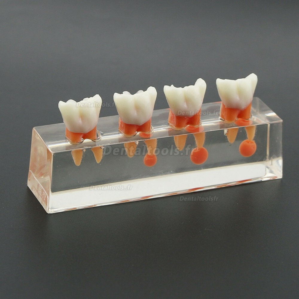 Traitement endodontique en 4 étapes du modèle de dents dentaires démontre le M4018-01 anatomique