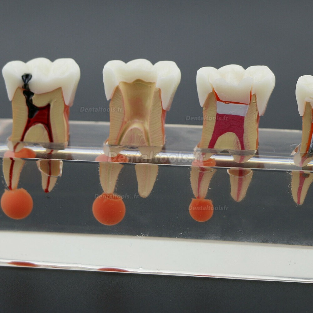 Traitement endodontique en 4 étapes du modèle de dents dentaires démontre le M4018-01 anatomique