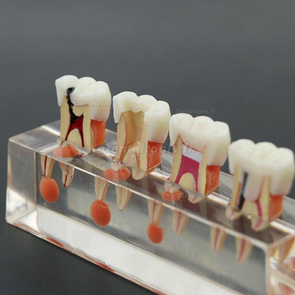 Traitement endodontique en 4 étapes du modèle de dents dentaires démontre le M4018-01 anatomique