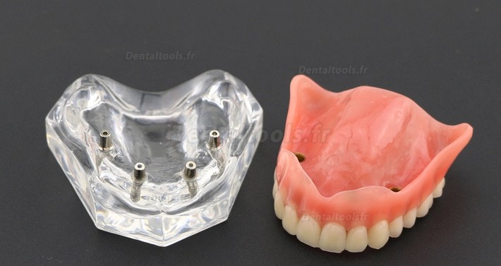 Prothèse Modèle Dentaire Couvert-dentier Inférieur avec 4 Implantations d’Étude de Démo Modèle 6001