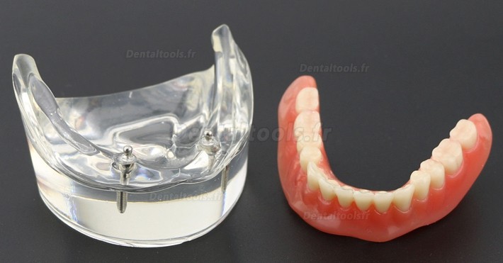Modèle Dentaire Couvert-dentier Inférieur avec 2 Implantations d’Étude de Démo Modèle 6002 01