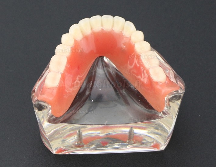Modèle Dentaire Couvert-dentier Inférieur avec 2 Implantations d’Étude de Démo Modèle 6002 01