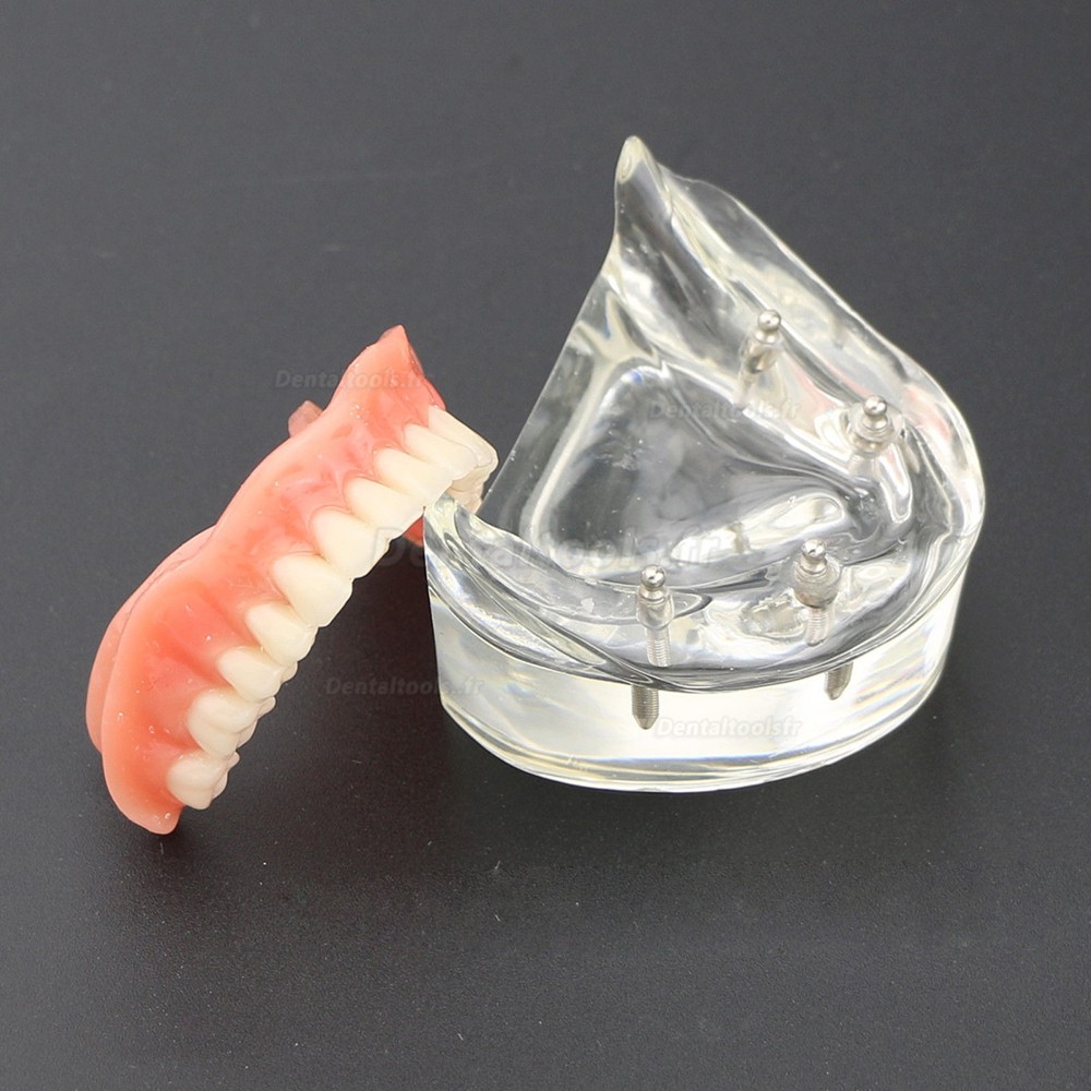 Modèle 6002 02 d’Overdenture Inférieure d’Étude de Démo de Dents Inférieures avec 4 Implants