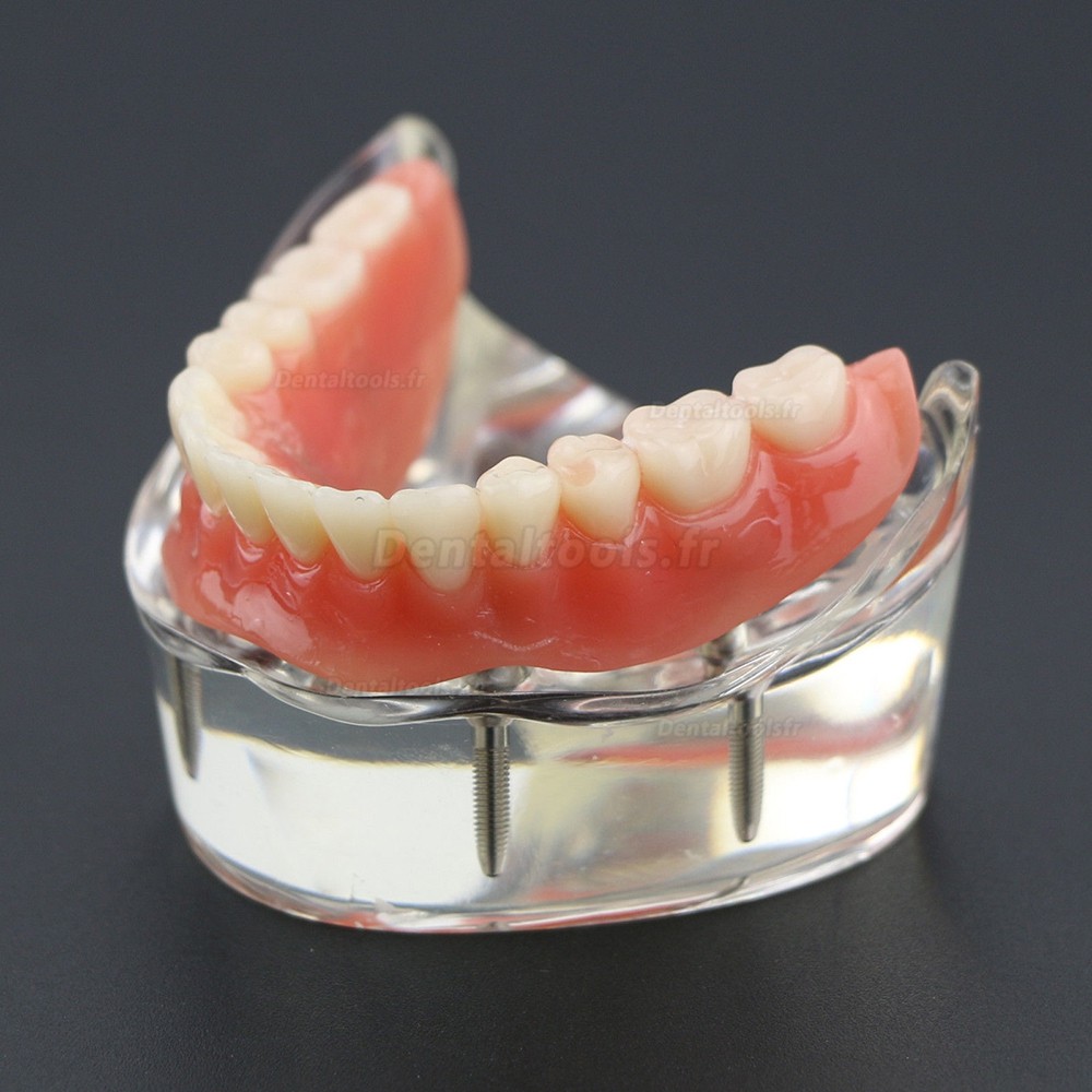 Modèle 6002 02 d’Overdenture Inférieure d’Étude de Démo de Dents Inférieures avec 4 Implants