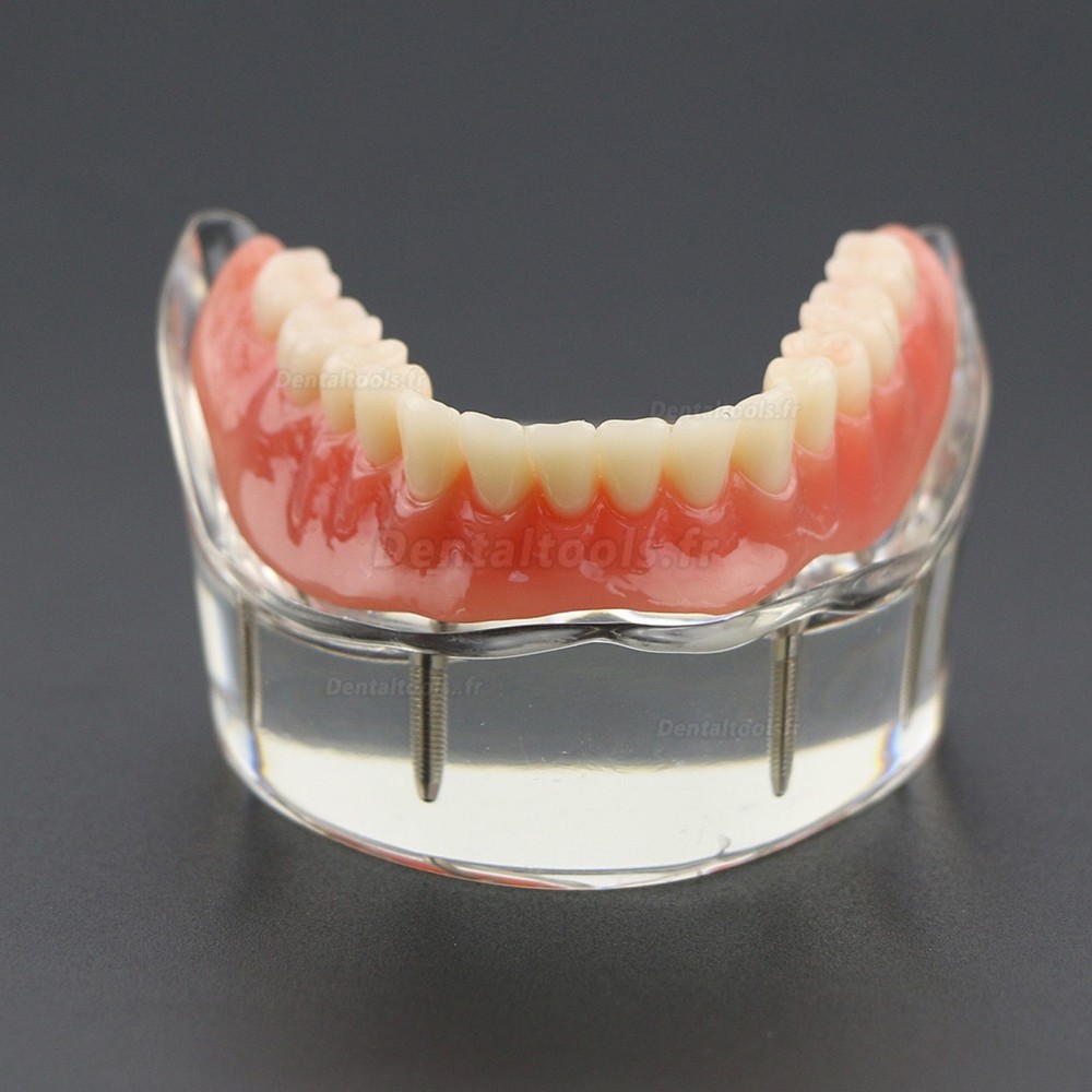 Modèle 6002 02 d’Overdenture Inférieure d’Étude de Démo de Dents Inférieures avec 4 Implants