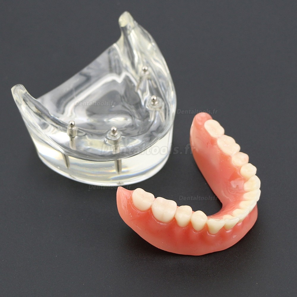 Modèle 6002 02 d’Overdenture Inférieure d’Étude de Démo de Dents Inférieures avec 4 Implants