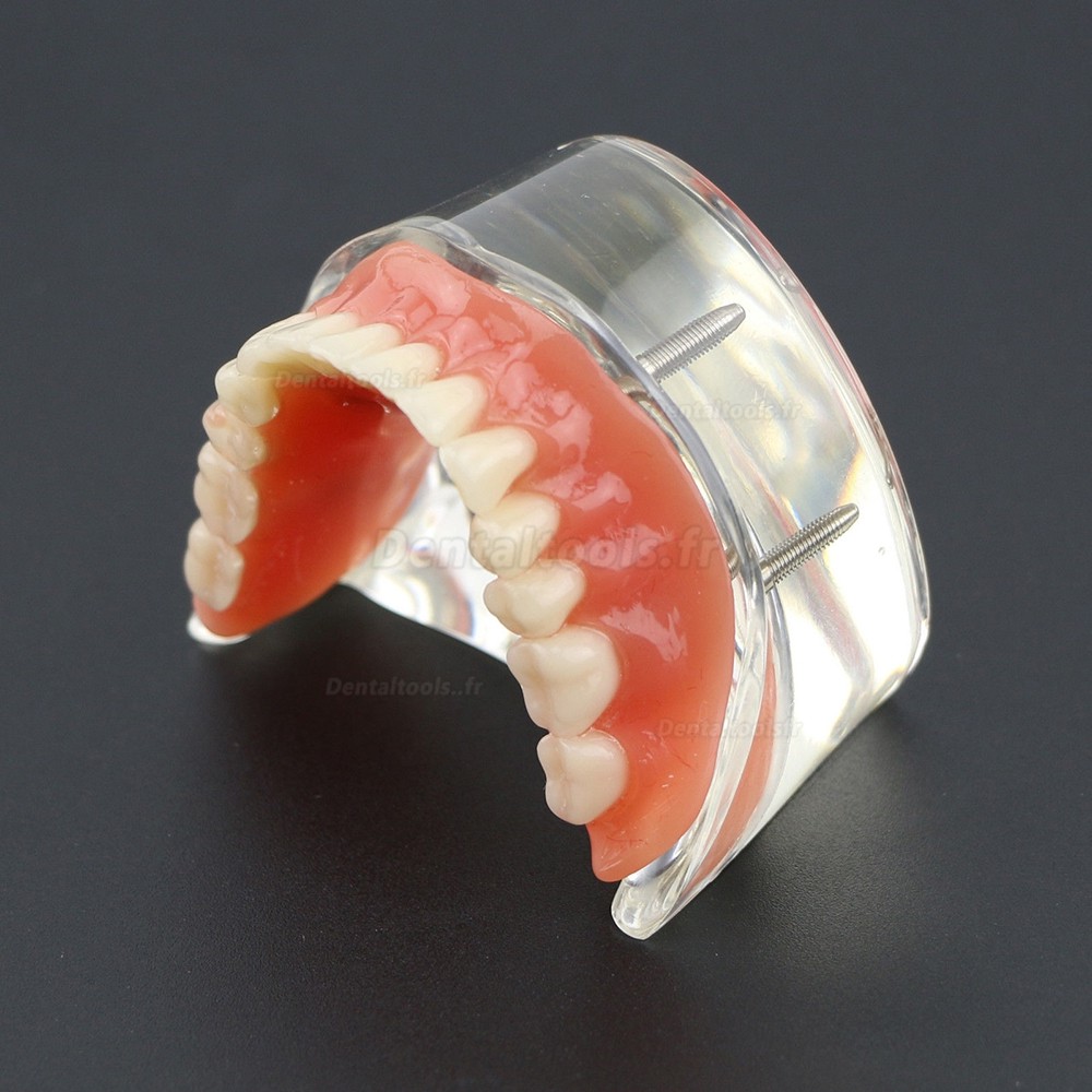 Modèle 6002 02 d’Overdenture Inférieure d’Étude de Démo de Dents Inférieures avec 4 Implants