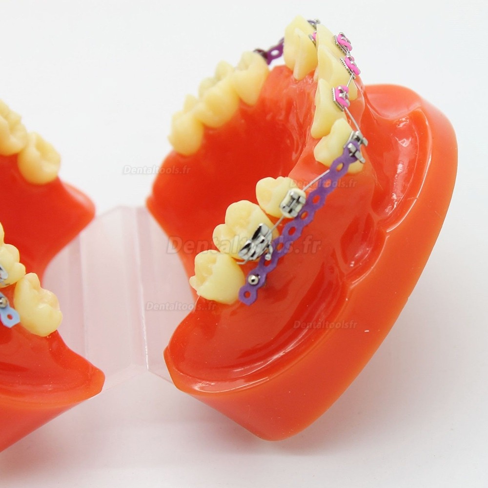 Modèle d'étude de traitement d'orthodontie dentaire avec support d'orthodontie et fil d'arc