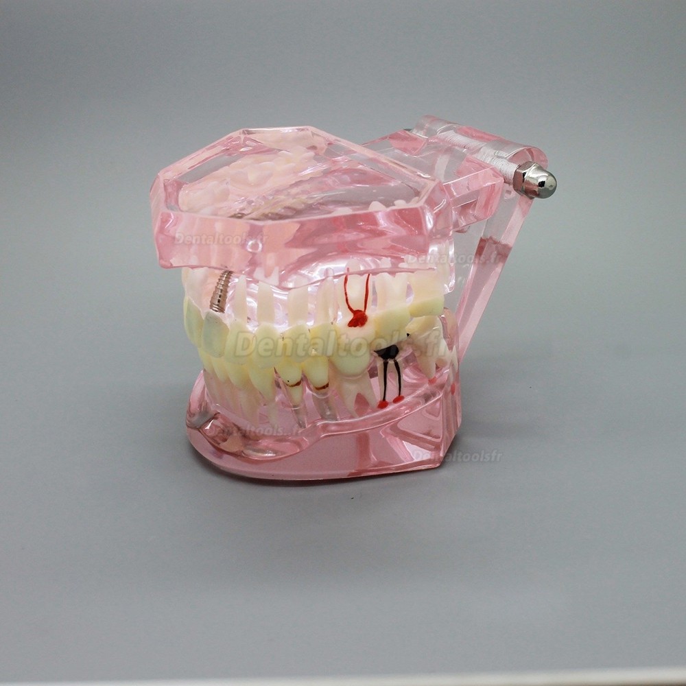 Implant dentaire supérieur de mâchoire Étude de chirurgie Dem 2005