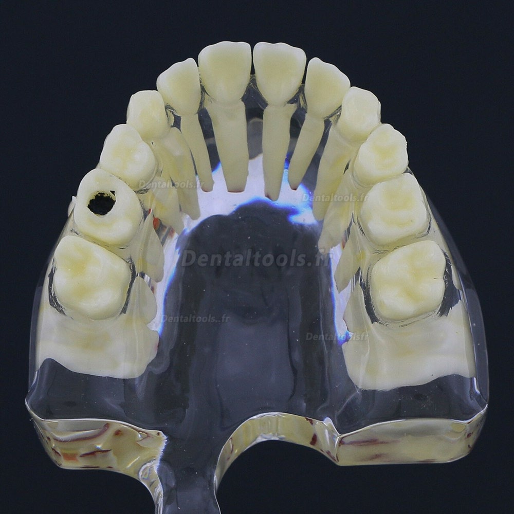 thumbnail image 2 of ALAN Pediatric Pathology Demonstration Tooth Model – Children's Dental Study Typodont 4002 2 of 5