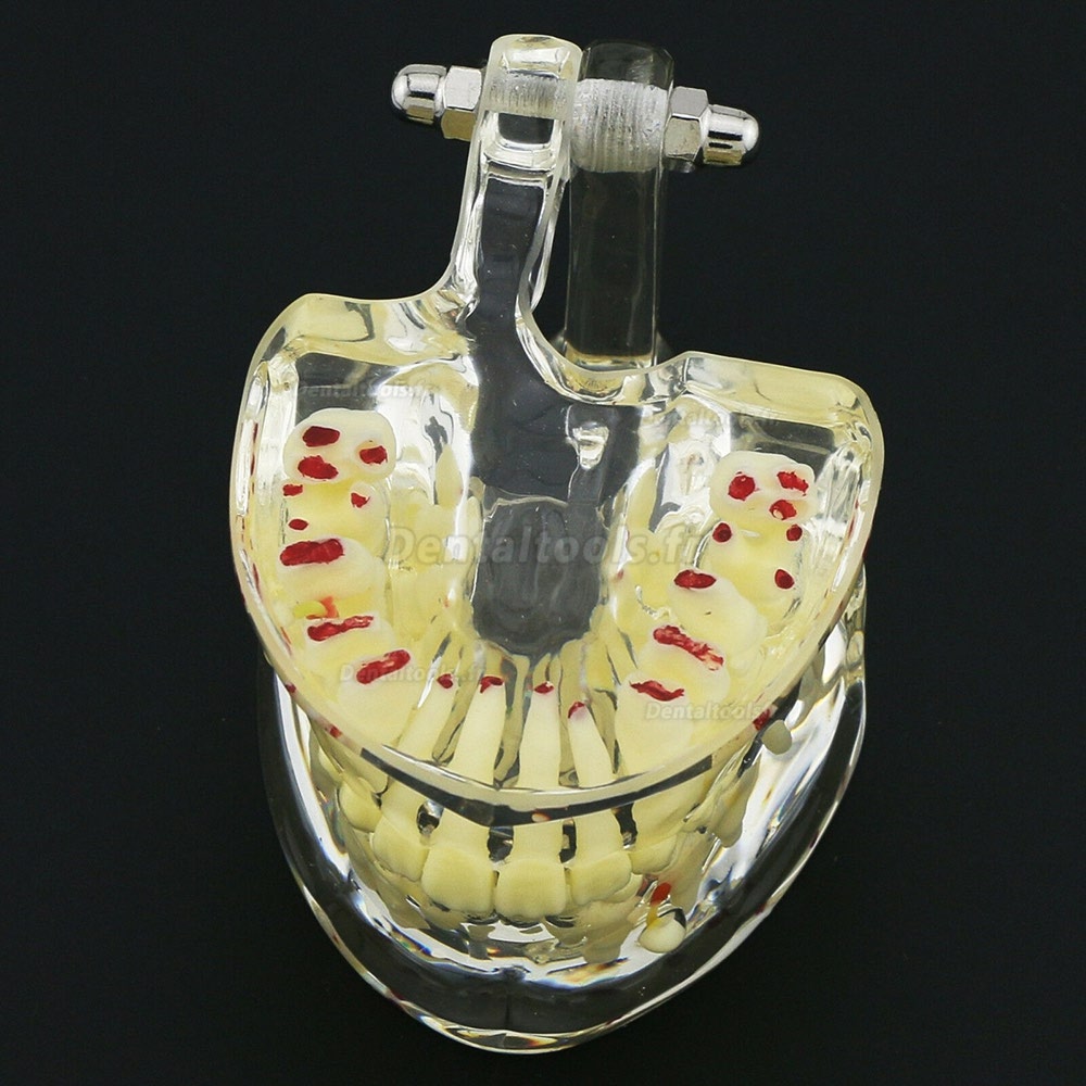 Modèle de dents d'enfants Modèle d'étude de démonstration en pathologie pédiatrique 4002