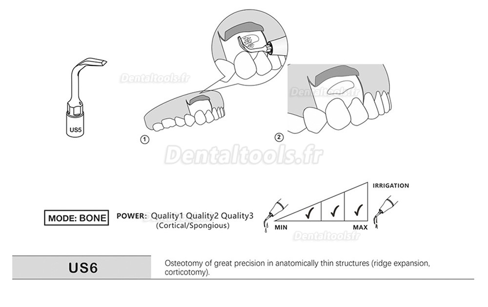 1Pcs Inserts piezochirurgie dentaire US1 US1L US1R US2 US3 US4 US5 US6 US7 US11 US12 compatible avec Mectron Woodpecker