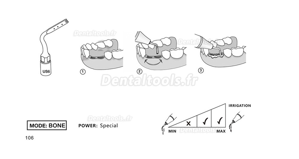 1Pcs Inserts piezochirurgie dentaire US1 US1L US1R US2 US3 US4 US5 US6 US7 US11 US12 compatible avec Mectron Woodpecker