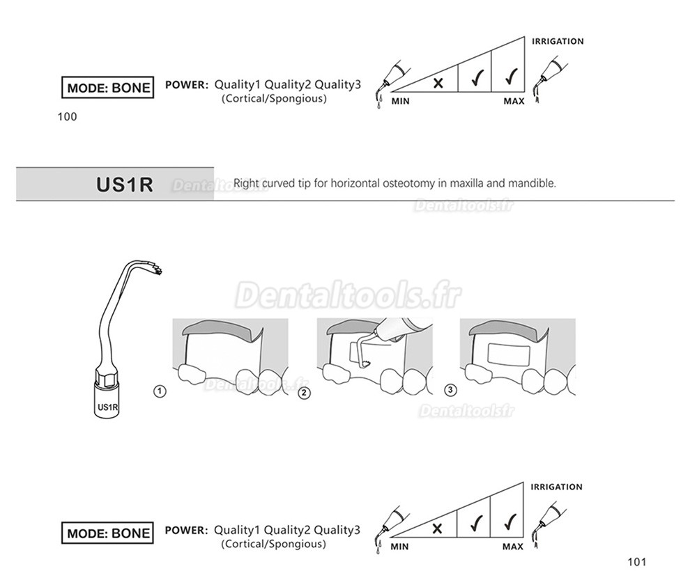 1Pcs Inserts piezochirurgie dentaire US1 US1L US1R US2 US3 US4 US5 US6 US7 US11 US12 compatible avec Mectron Woodpecker