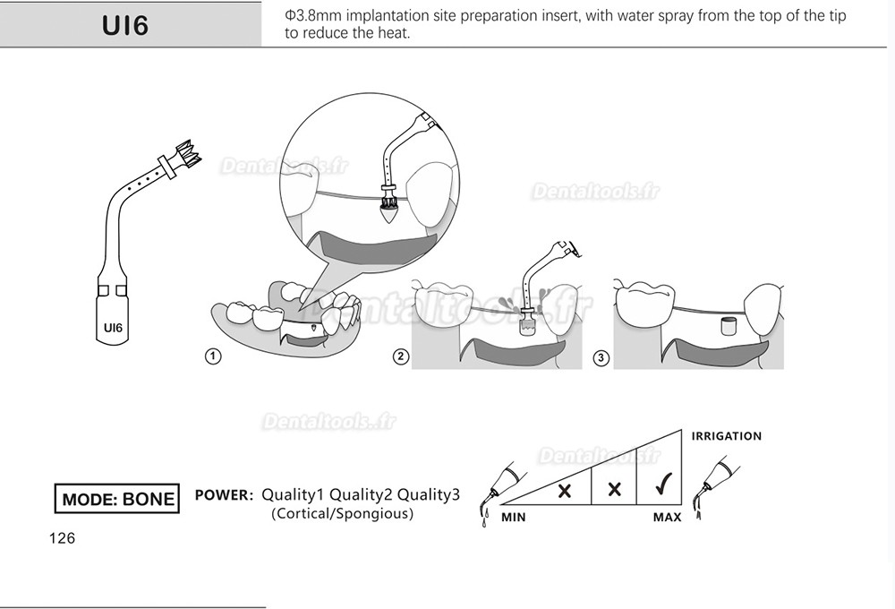 1Pcs inserts de piézochirurgie dentaire pour l'implant de levage des sinus de coupe osseuse Ul1 UI2 UI3 UI4 UI5 compatible avec Mectron Woodpecker