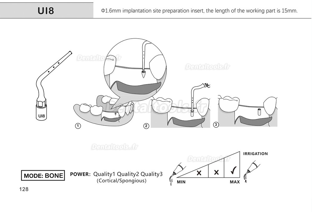 1Pcs inserts de piézochirurgie dentaire pour l'implant de levage des sinus de coupe osseuse Ul1 UI2 UI3 UI4 UI5 compatible avec Mectron Woodpecker