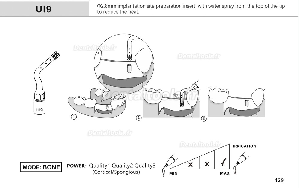 1Pcs inserts de piézochirurgie dentaire pour l'implant de levage des sinus de coupe osseuse Ul1 UI2 UI3 UI4 UI5 compatible avec Mectron Woodpecker