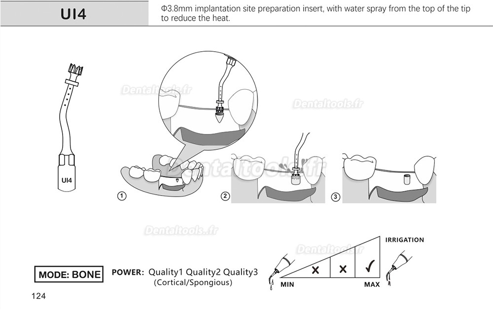 1Pcs inserts de piézochirurgie dentaire pour l'implant de levage des sinus de coupe osseuse Ul1 UI2 UI3 UI4 UI5 compatible avec Mectron Woodpecker