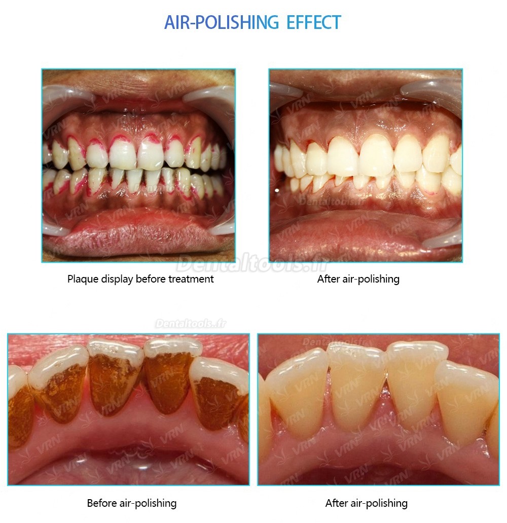 Vrn Q6 6 IN 1 Détartreur à Ultrasons + Aéropolisseur (Détartrage/ Implant / Parodontal/ Traitement Canalaire ) Vrn Q6 6 IN 1 Détartreur à Ultrasons + Aéropolisseur (Détartrage/ Implant / Parodontal/ Traitement Canalaire )