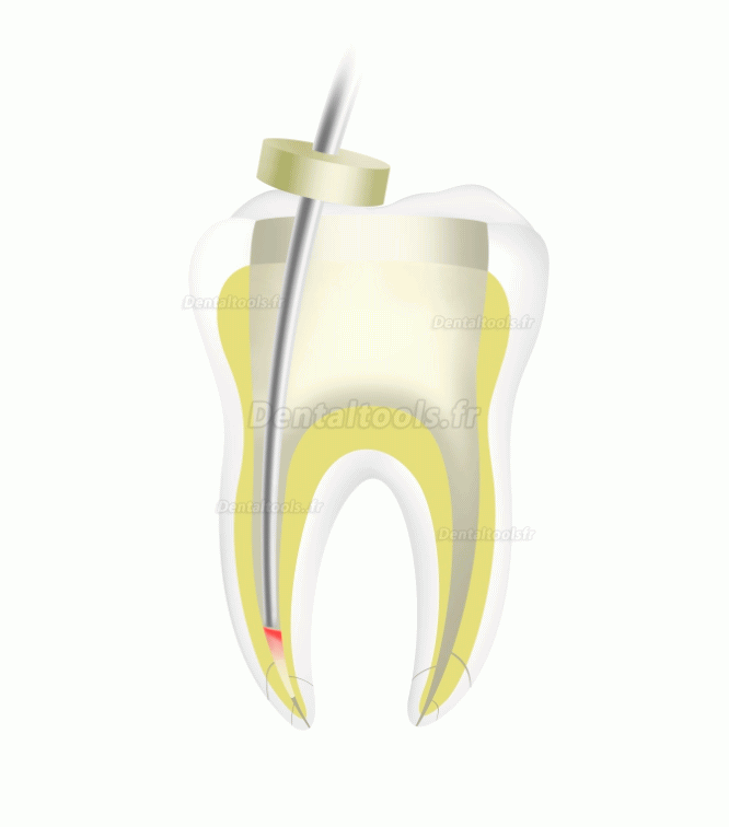 Woodpecker Fi-P Dental Stylo d'obturation endo-gutta-percha sans fil