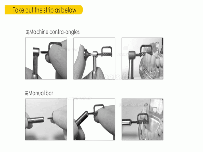 XM dentaire orthodontique IPR interproximal émaillage réduction des bandes EVA