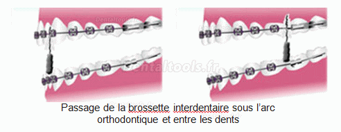 Dents de sagesse et orthodontie: sont-elles liées?