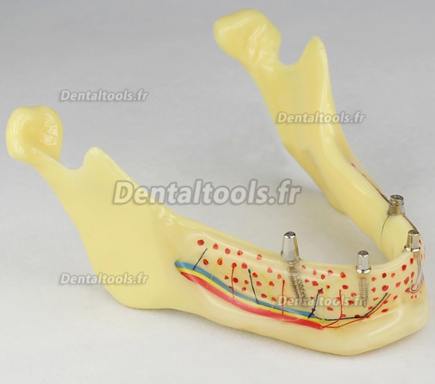 Modèle anatomique dentaire prothèse dentaire invisible M-2014b